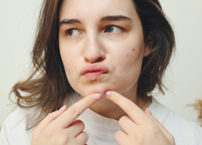 Hormonal Acne: Causes, Treatment, and Prevention