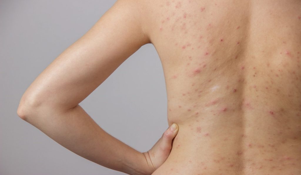 Body Acne Decoded: The Ultimate Guide to Clear Skin