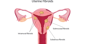 Dispelling Common Misconceptions About Fibroids