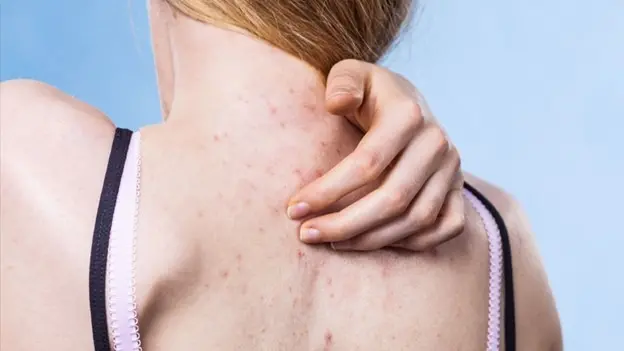 The Real Deal on Body Acne: Causes, Treatments, and Tips