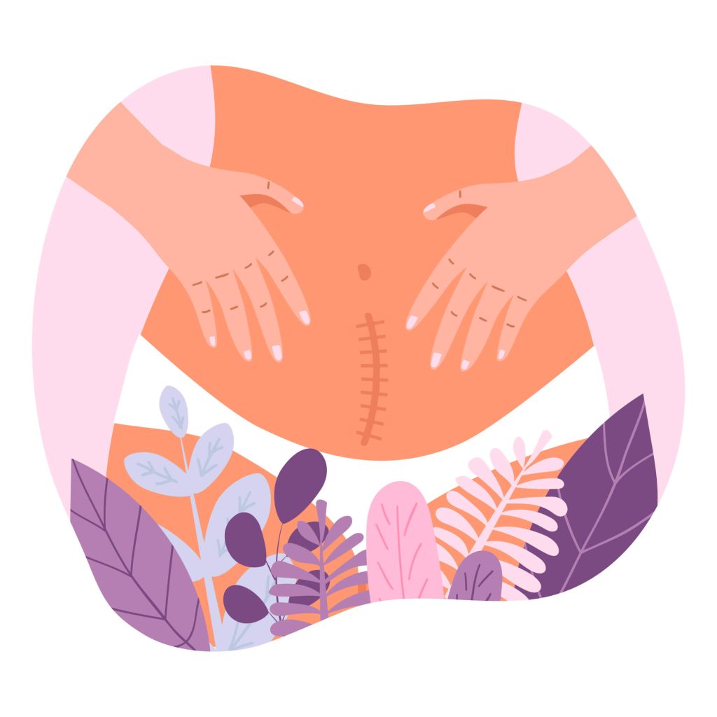 Periods After C-Section